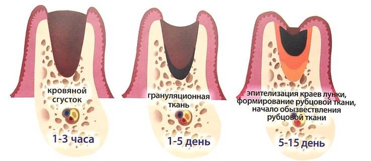 этапы заживления десны после удаления зуба