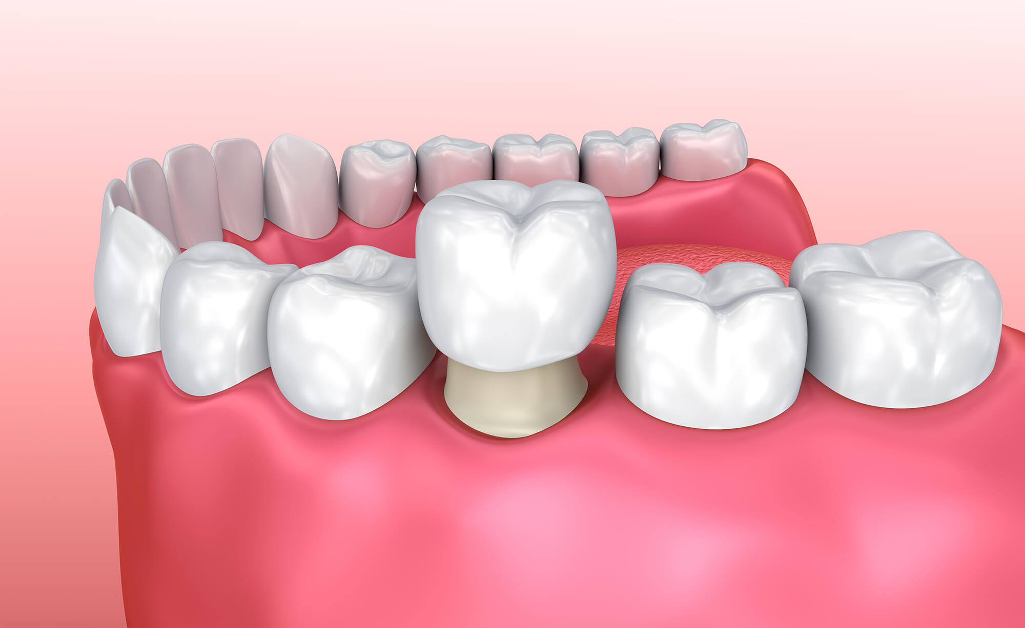 керамические мосты для зубов
