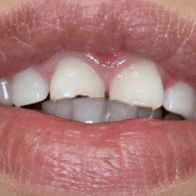 выровнять форму зубов в хабаровске