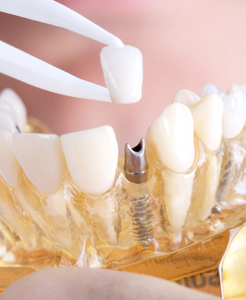 протезирование зубов в хабаровске