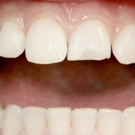 убрать дырки между зубами